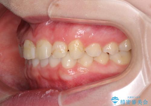 気になる前歯を美しく マウスピース矯正とセラミッククラウンの治療中