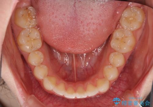 気になる前歯を美しく マウスピース矯正とセラミッククラウンの治療中