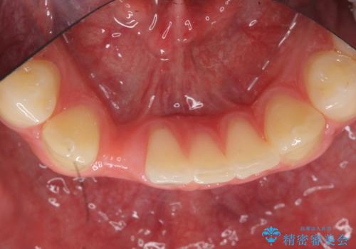 下の前歯のインプラント　生まれつき歯が少ないの治療前