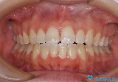 【モニター】オープンバイトをインビザラインで矯正治療の治療中