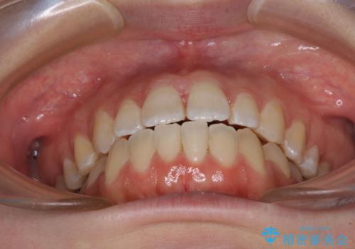 【モニター】オープンバイトをインビザラインで矯正治療の治療中