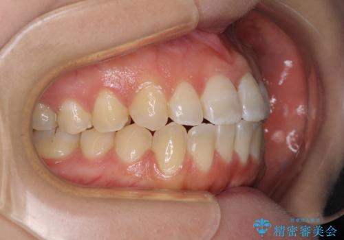 【モニター】オープンバイトをインビザラインで矯正治療の治療中