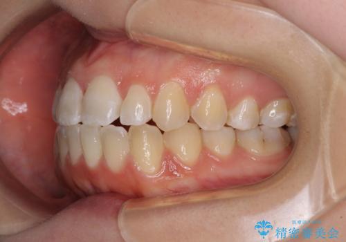 【モニター】オープンバイトをインビザラインで矯正治療の治療中