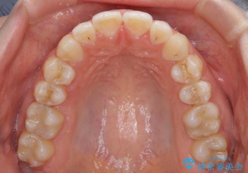 【モニター】オープンバイトをインビザラインで矯正治療の治療中