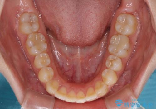 【モニター】オープンバイトをインビザラインで矯正治療の治療中