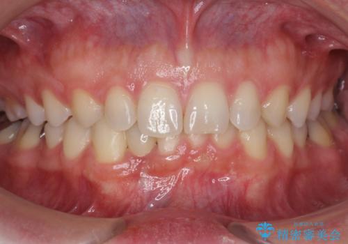 すきっ歯・出っ歯　コンプレックスの前歯を治したい　目立たない方法で　セラミック治療は不可能な症例の症例 治療後