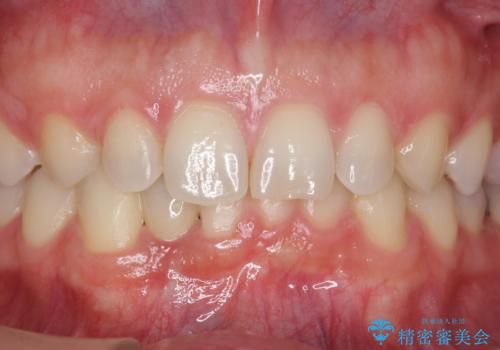 下の前歯のインプラント　生まれつき歯が少ないの治療後