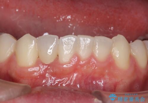下の前歯のインプラント　生まれつき歯が少ないの治療後