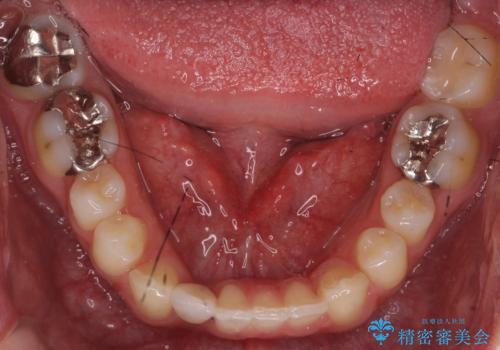 すきっ歯・出っ歯 コンプレックスの前歯を治したい 目立たない方法で セラミック治療は不可能な症例の治療後