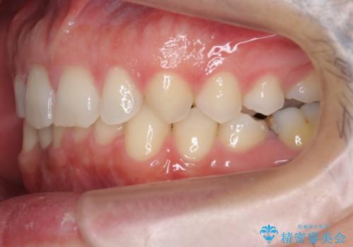 すきっ歯・出っ歯 コンプレックスの前歯を治したい 目立たない方法で セラミック治療は不可能な症例の治療後