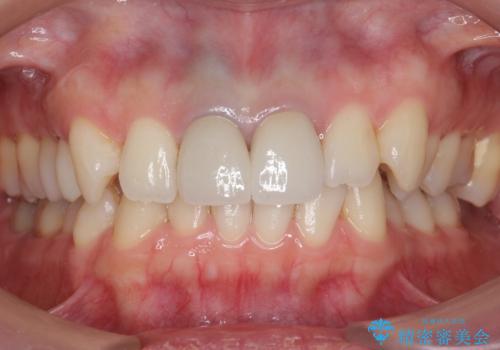 神経をとった前歯が変色してきたの治療後