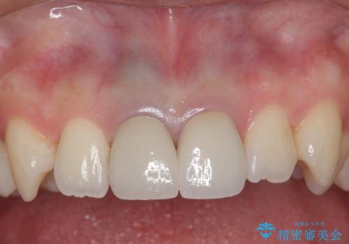 神経をとった前歯が変色してきたの症例 治療後