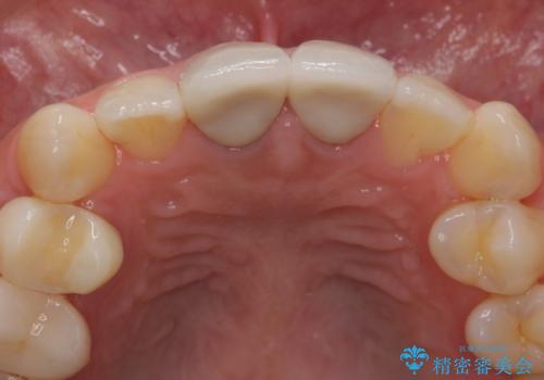 神経をとった前歯が変色してきたの治療後