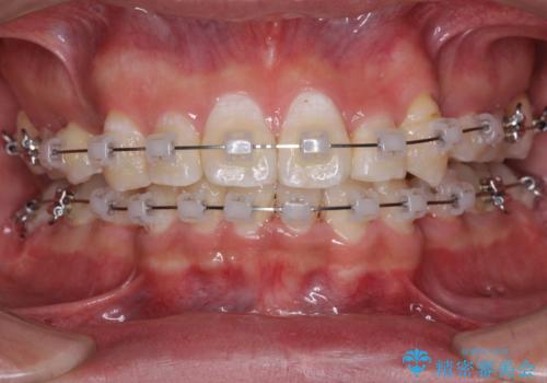 前歯の叢生を解消　ワイヤー装置での抜歯矯正の治療中