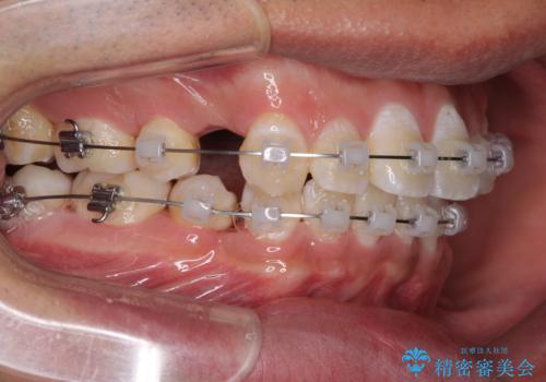 前歯の叢生を解消　ワイヤー装置での抜歯矯正の治療中