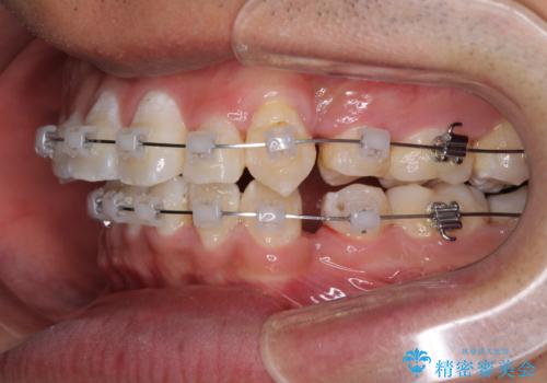 前歯の叢生を解消　ワイヤー装置での抜歯矯正の治療中