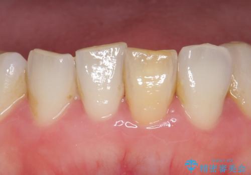 オールセラミッククラウン 変色した前歯をセラミックで白くの症例 治療前