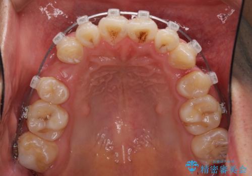 前歯の叢生を解消　ワイヤー装置での抜歯矯正の治療中
