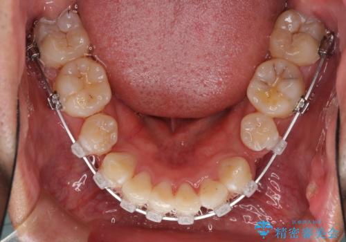 前歯の叢生を解消 ワイヤー装置での抜歯矯正の治療中