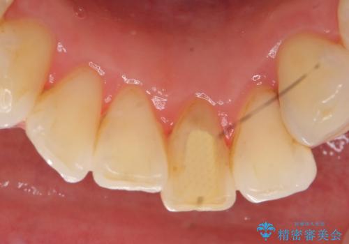 オールセラミッククラウン 変色した前歯をセラミックで白くの治療前