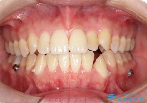 仕事上装置をつけることができない インビザラインで目立たない矯正の治療中