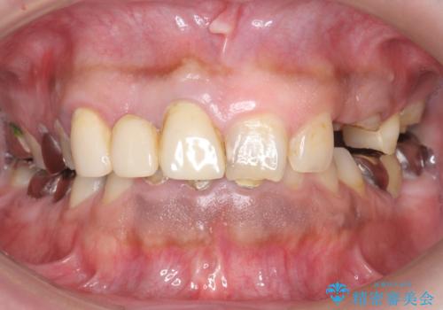 オールセラミッククラウン ブリッジによる欠損歯の補綴の治療前