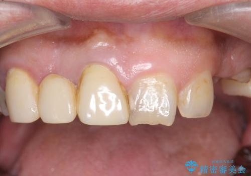 オールセラミッククラウン ブリッジによる欠損歯の補綴の治療前