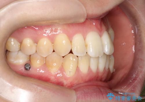 仕事上装置をつけることができない インビザラインで目立たない矯正の治療中