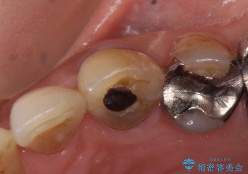 オールセラミッククラウン 再根管治療後の補綴の治療前