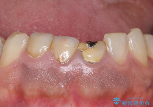 オールセラミッククラウン　ブリッジによる欠損歯の補綴の治療前