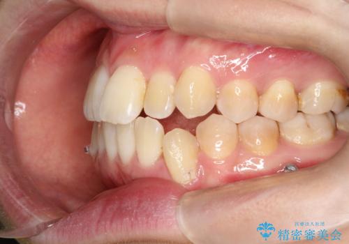 仕事上装置をつけることができない インビザラインで目立たない矯正の治療中