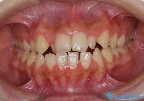 外科矯正は受けたくない 上顎骨拡大による妥協的な受け口治療の治療前