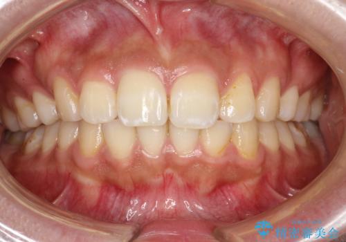 歯科医院で初めてのクリーニング PMTC30分コースの治療前