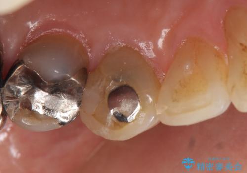 オールセラミッククラウン 再根管治療後の補綴の治療前