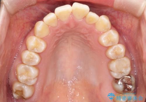 仕事上装置をつけることができない インビザラインで目立たない矯正の治療中