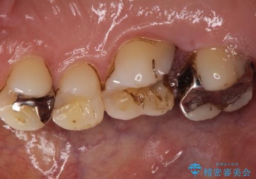 銀歯が外れてしまった ゴールドインレーによる補綴治療の治療前
