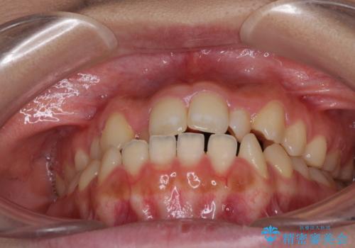 外科矯正は受けたくない 上顎骨拡大による妥協的な受け口治療の治療前