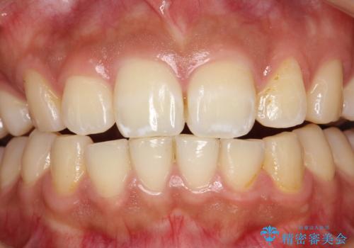 歯科医院で初めてのクリーニング PMTC30分コースの治療前