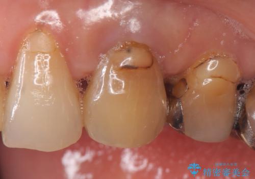 オールセラミッククラウン 再根管治療後の補綴の症例 治療前