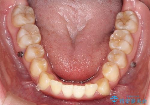 仕事上装置をつけることができない インビザラインで目立たない矯正の治療中