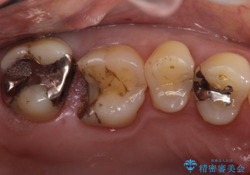 銀歯が外れてしまった ゴールドインレーによる補綴治療の治療前