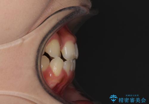 外科矯正は受けたくない 上顎骨拡大による妥協的な受け口治療の治療前