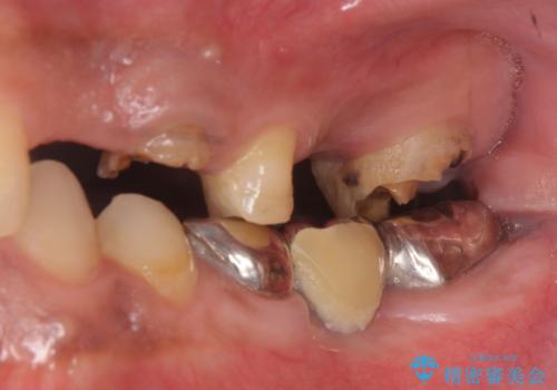 オールセラミッククラウン ブリッジによる欠損歯の補綴の治療前