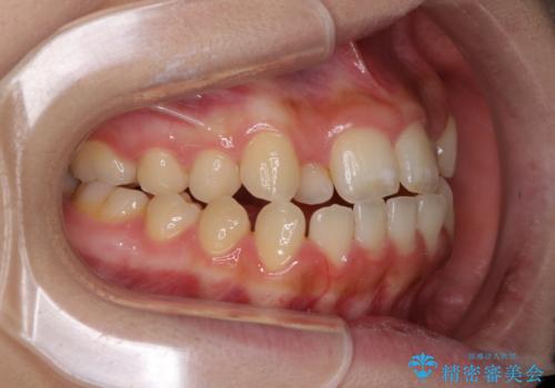 外科矯正は受けたくない 上顎骨拡大による妥協的な受け口治療の治療前