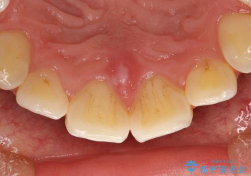歯科医院で初めてのクリーニング PMTC30分コースの治療前