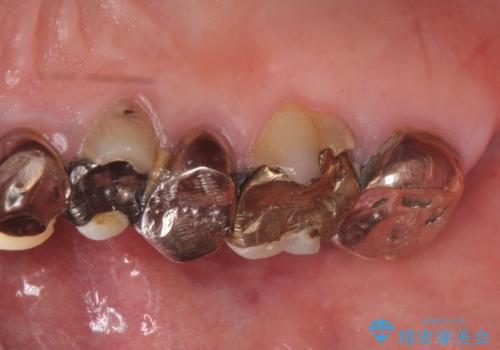 オールセラミッククラウン ブリッジによる欠損歯の補綴の治療前