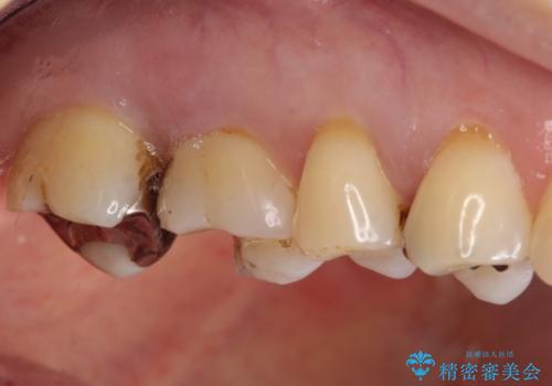 銀歯が外れてしまった ゴールドインレーによる補綴治療の治療前