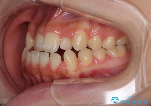 外科矯正は受けたくない 上顎骨拡大による妥協的な受け口治療の治療前