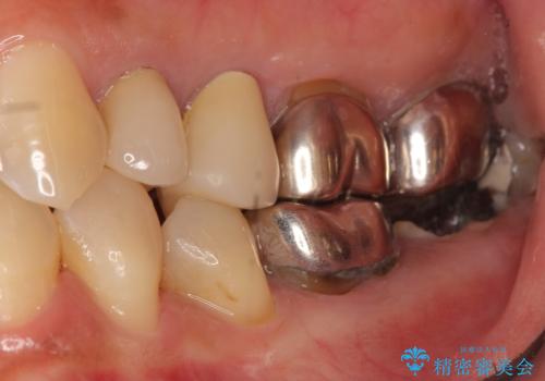 インプラントは嫌 親知らずの移植 50代女性の治療前