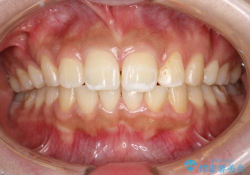 歯科医院で初めてのクリーニング PMTC30分コースの治療後